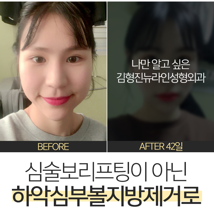 심술보리프팅 김형진뉴라인에서는? 관련 이미지 2