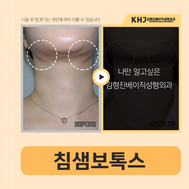 침샘비대증치료 이거 하나면 끝! 관련 이미지 3