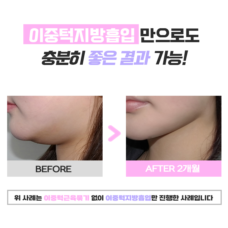 How to Get Rid of a Double Chin—What Everyone Is Doing These Days image 6