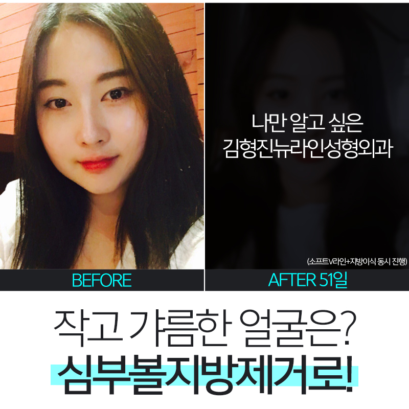 비수술안면윤곽 이거 완전 그뤠잇! 관련 이미지 4