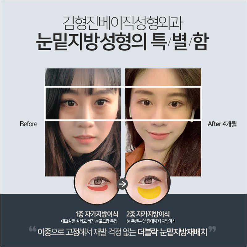 눈밑지방재배치변화과정 한눈에 확인하고 가세요! 관련 이미지 2