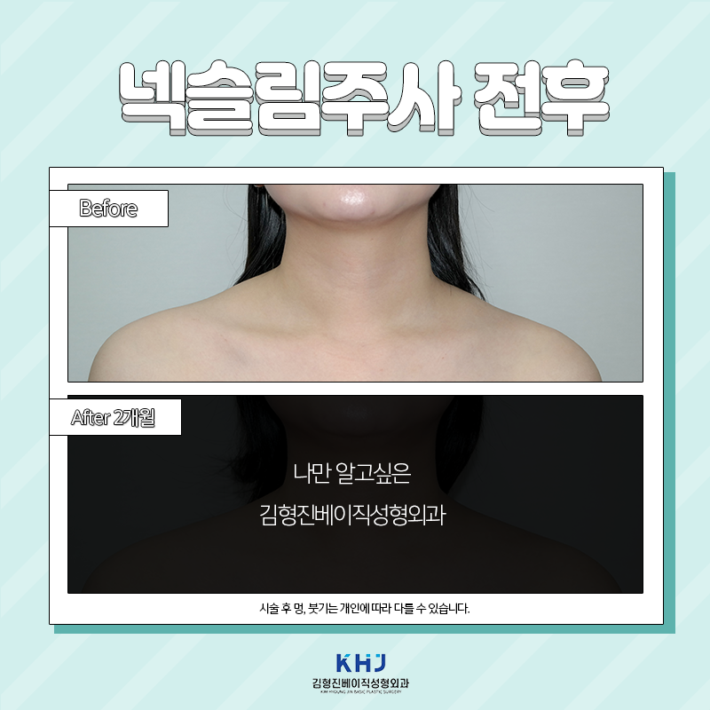 넥슬림주사전후 궁금하셨다면 보고 가세요! 관련 이미지 5