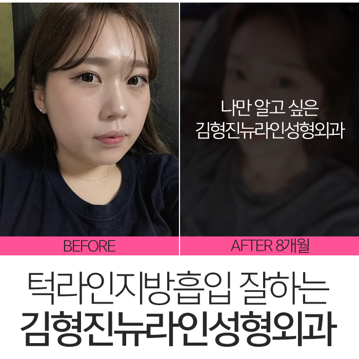 턱라인지방흡입 김형진원장이 체고야! 관련 이미지 3