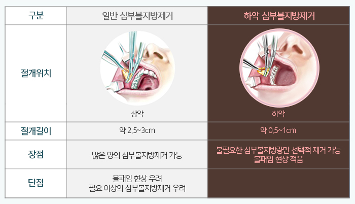 늘어진볼살 제거하는법이 궁금해? 관련 이미지 5