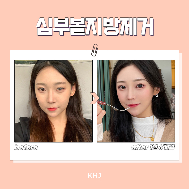 압구정심부볼지방제거 볼패임 걱정할 필요 없었어요 관련 이미지 6