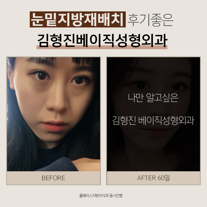 눈밑지방재배치후기 봐주실 분 관련 이미지 2