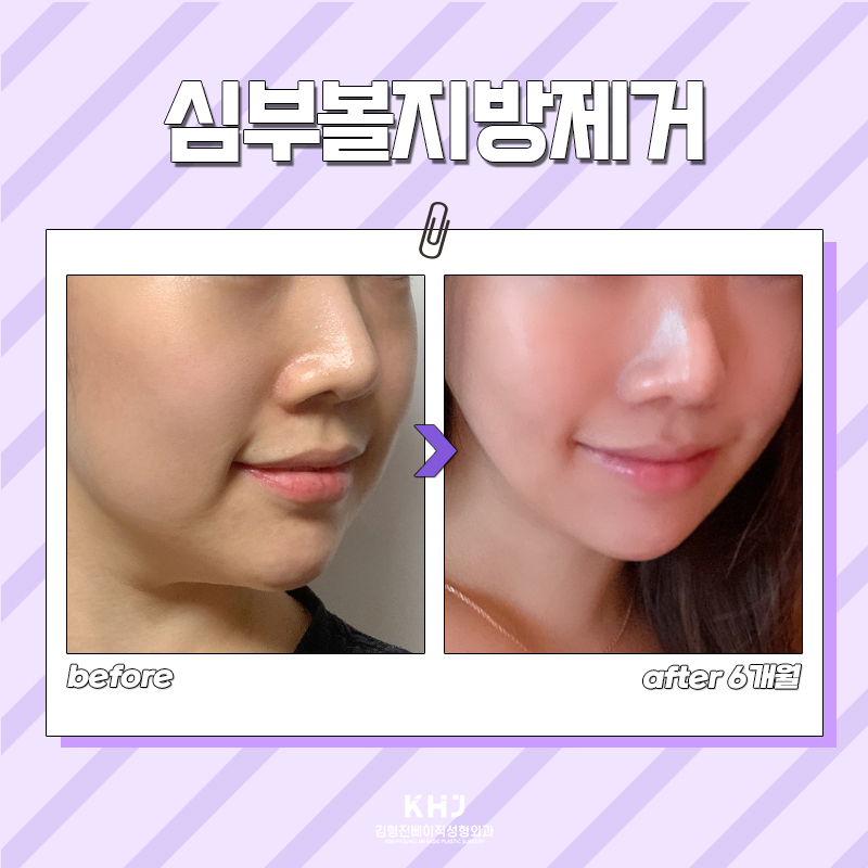 얼굴이 작아 보이는 비결, 심부볼제거술로 V라인 완성 관련 이미지 5