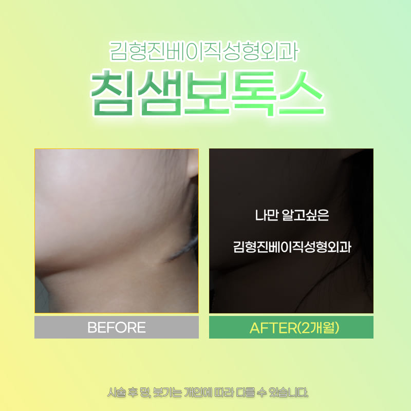 턱 라인 살리는 침샘보톡스효과 궁금한 사람! 관련 이미지 5