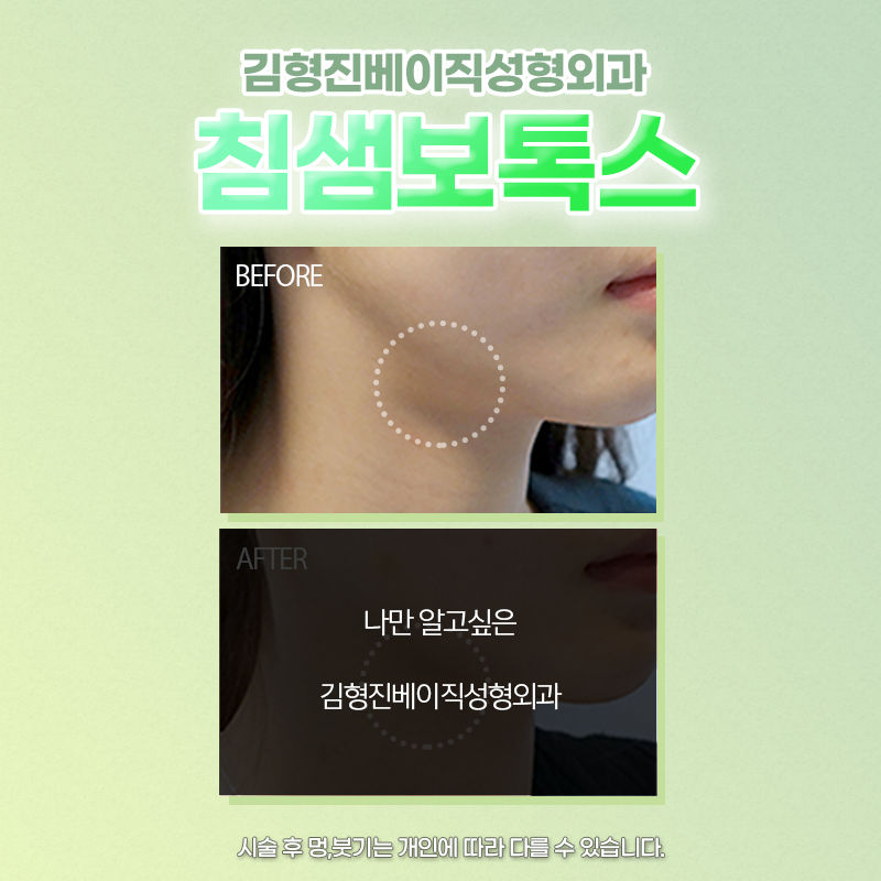 침샘보톡스효과 아직도 모르셨다면 관련 이미지 5