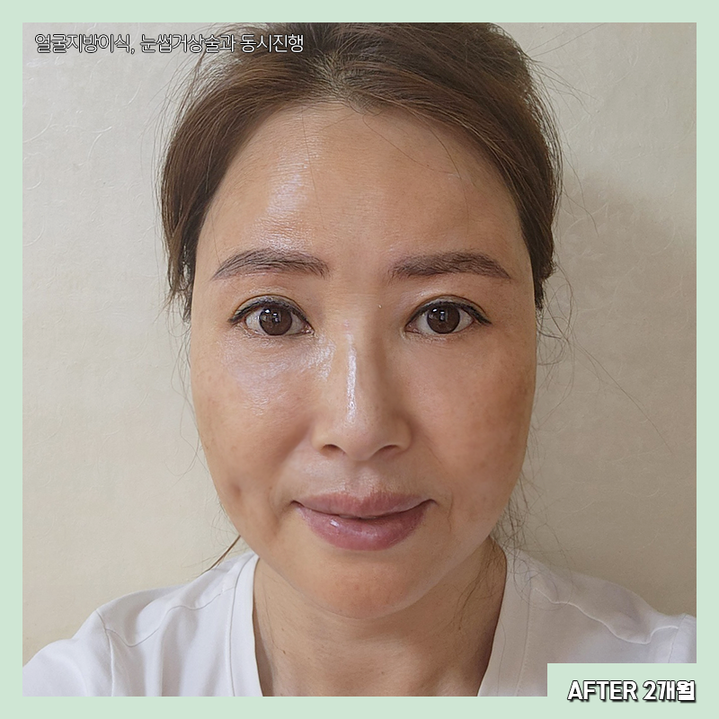 미니하안검수술 아직도 모르시나요? 관련 이미지 4