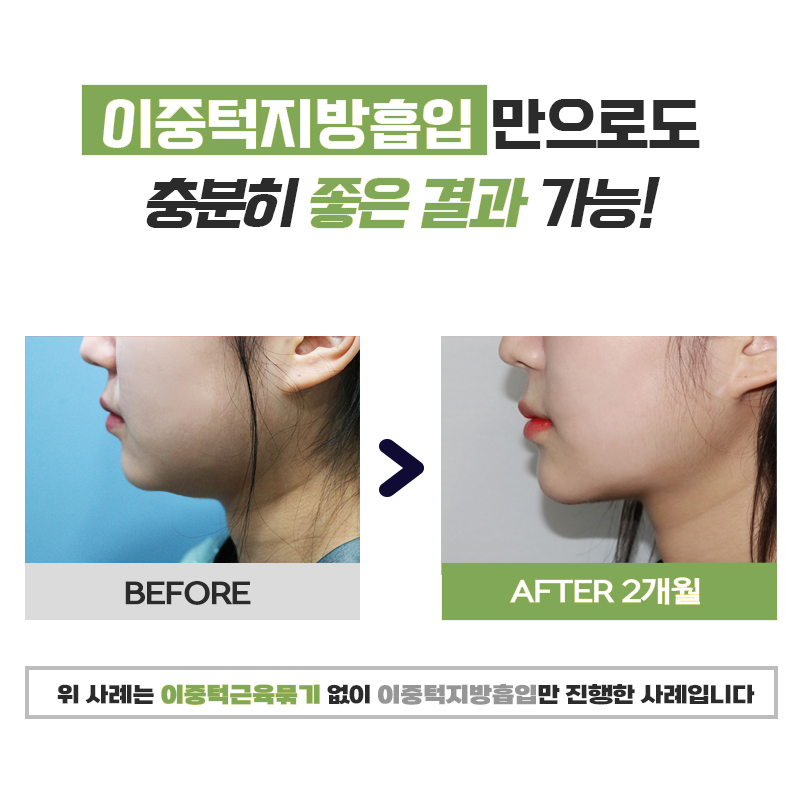 확실하게 이중턱지방빼는법 알고싶다면 관련 이미지 6