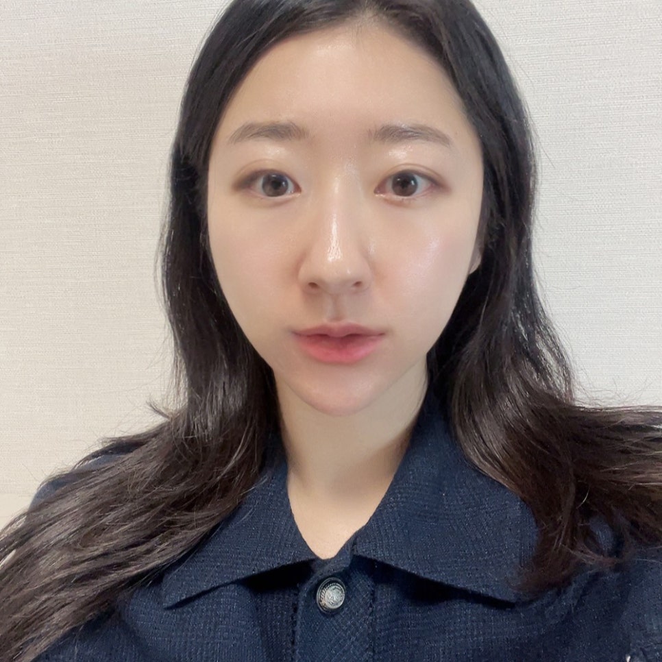 침샘시술전후 실력 좋은 곳에서 관련 이미지 4