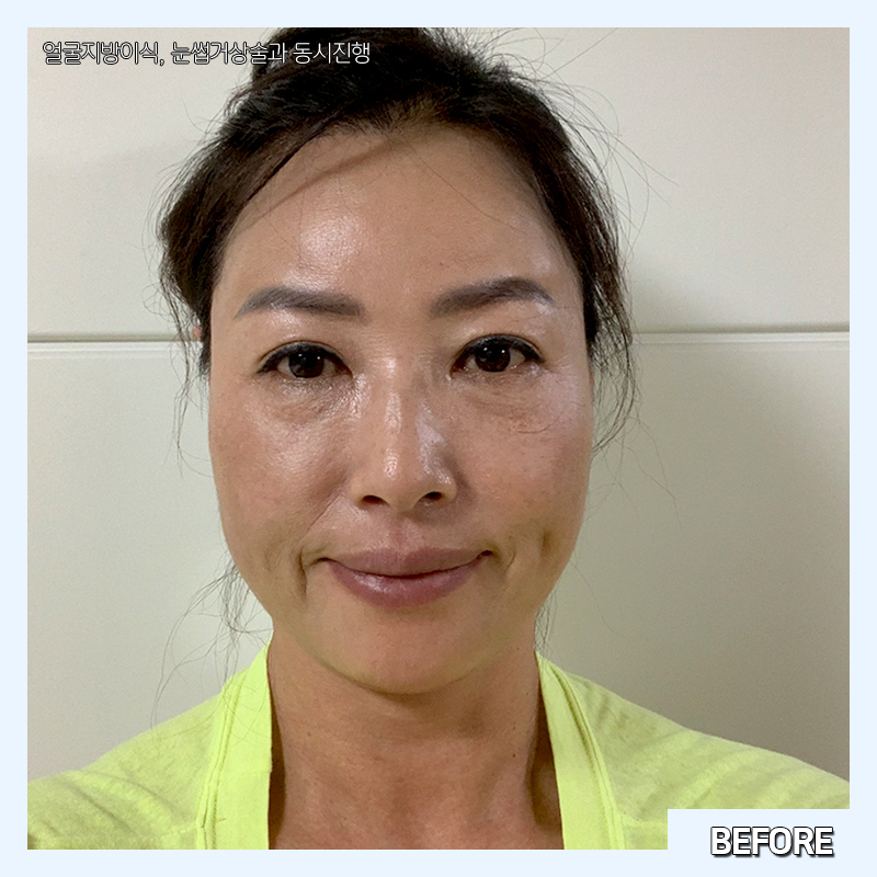 미니하안검효과 이렇게나 좋다구요! 관련 이미지 3