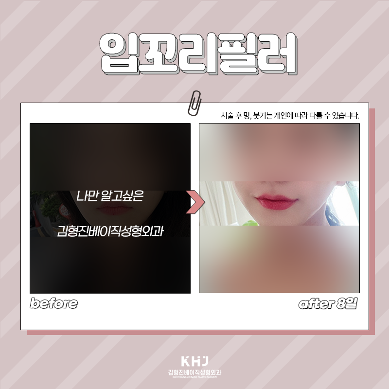 입꼬리비대칭 개선하는 방법 찾으셨다면 관련 이미지 4