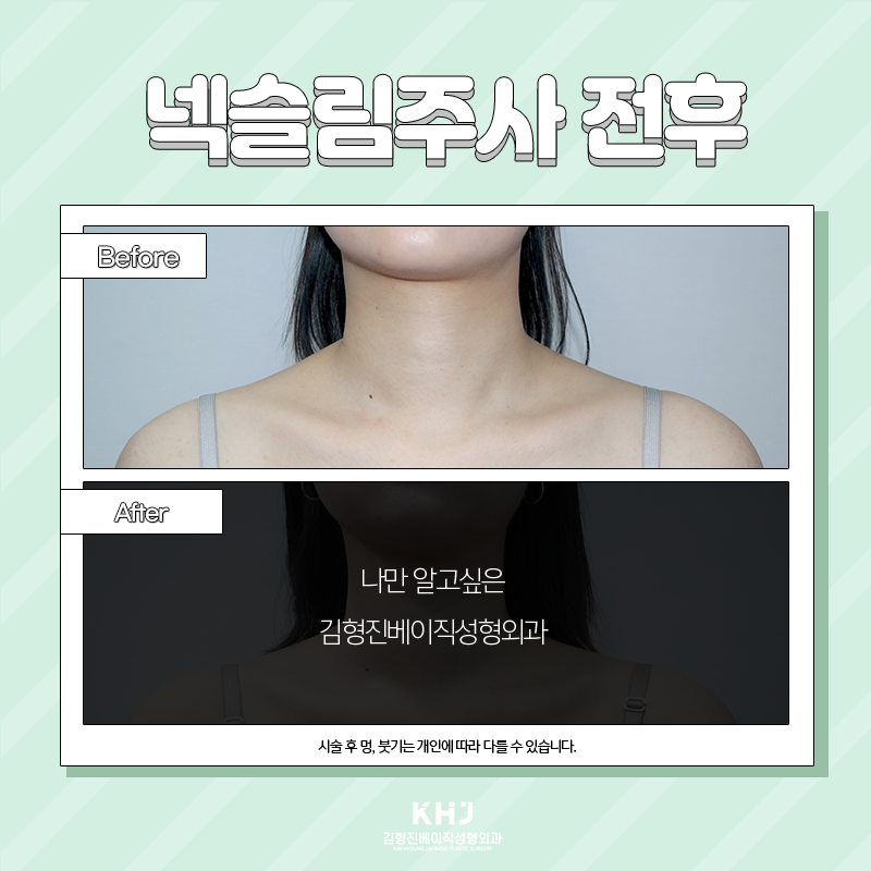 두꺼운목 해결방법 여기에요! 관련 이미지 5