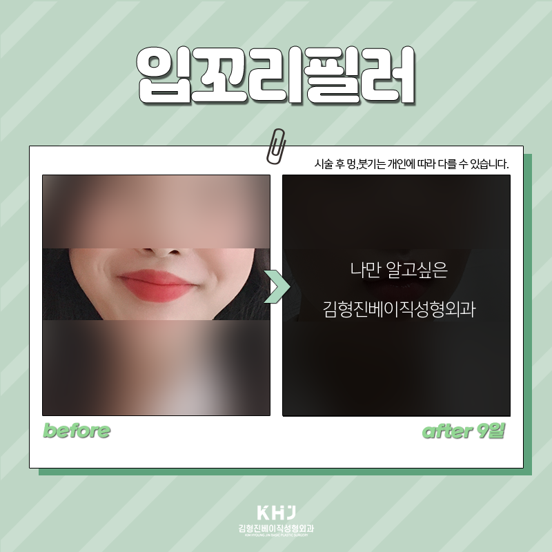 입꼬리필러모양 섬세하게 잡아줄 수 있는 곳에서 하셔야죠 관련 이미지 3