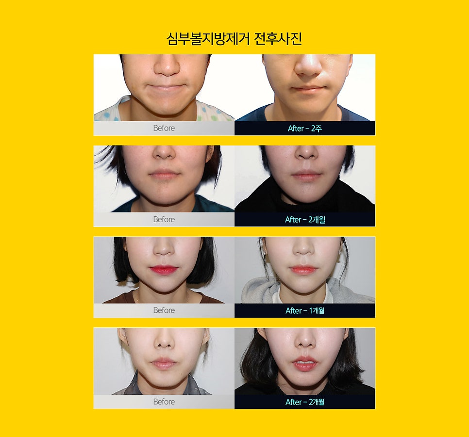 심부볼리프팅 해도 소용없다가 제거하고 광명 찾았어요 관련 이미지 5