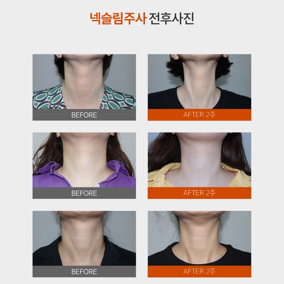 넥슬림주사시술로 얇고 여리여리한 목라인을 가지고 싶다면 관련 이미지 5