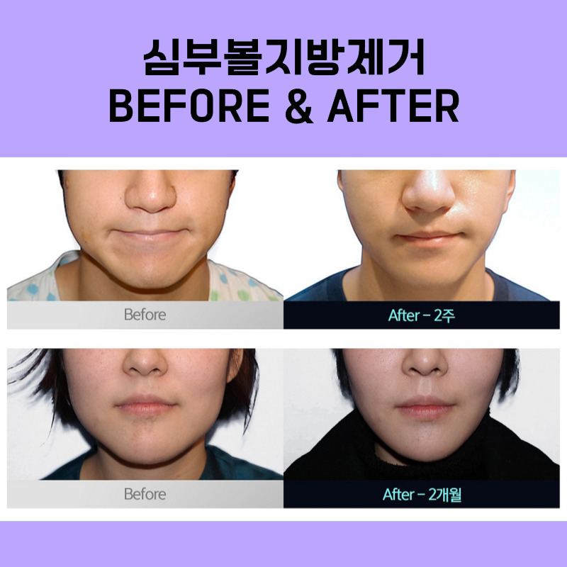 빠르게 볼살제거하는법 왜 이제 알았을까요? 관련 이미지 5