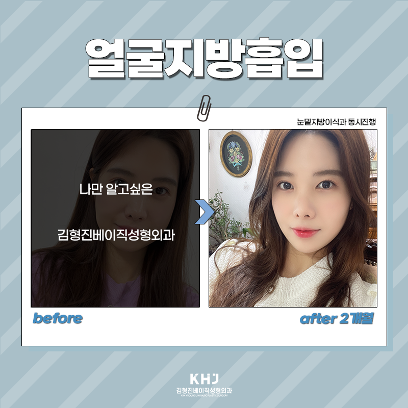 얼굴지흡후기 확인하고 가실 분~! 관련 이미지 3