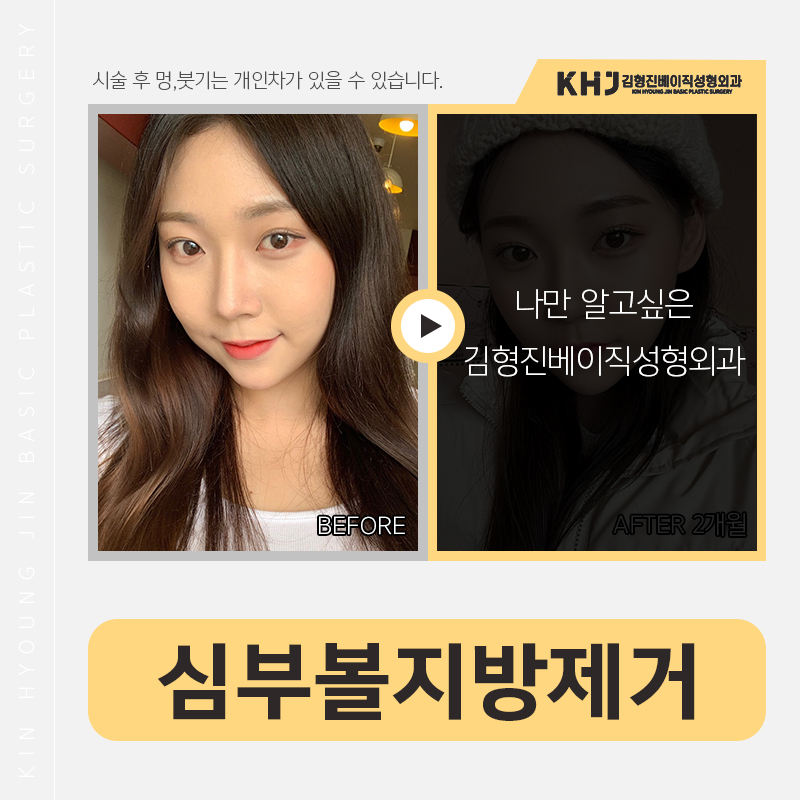 심부볼제거 부작용 걱정 왜 해요? 관련 이미지 2