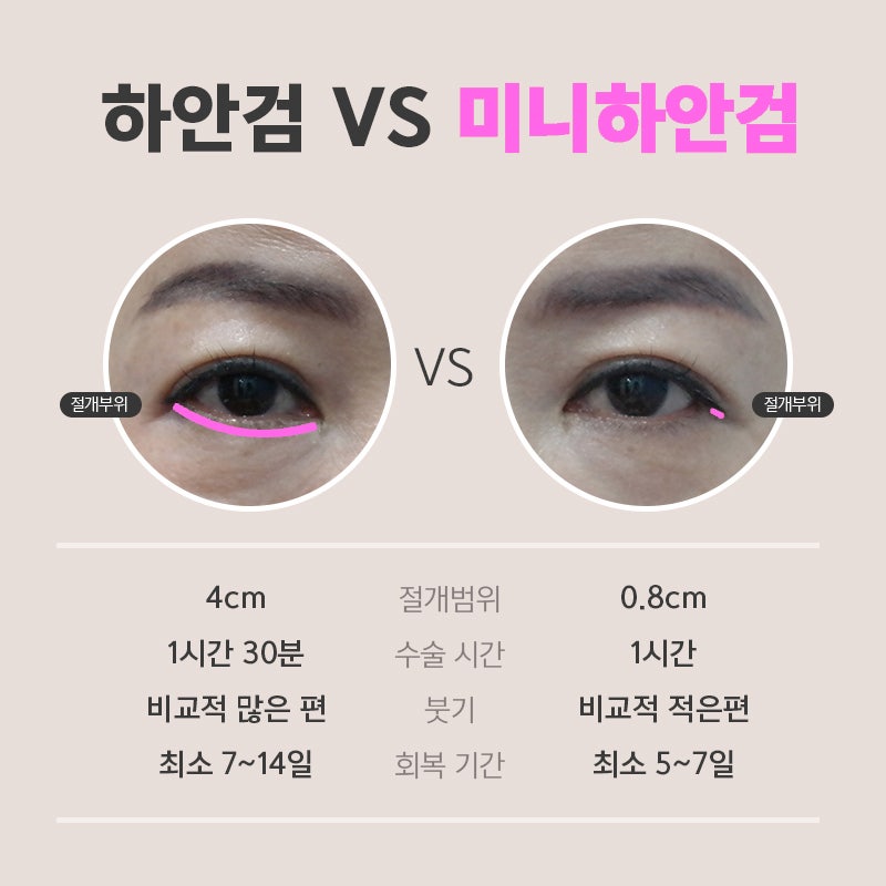 Middle-Aged Under-Eye Surgery Review: I Look Younger After Mini Lower Blepharoplasty image 4