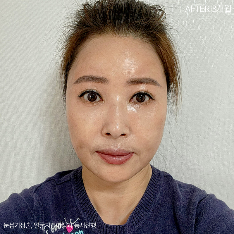중년눈밑지방 고민은 김형진베이직에서 해결! 관련 이미지 5