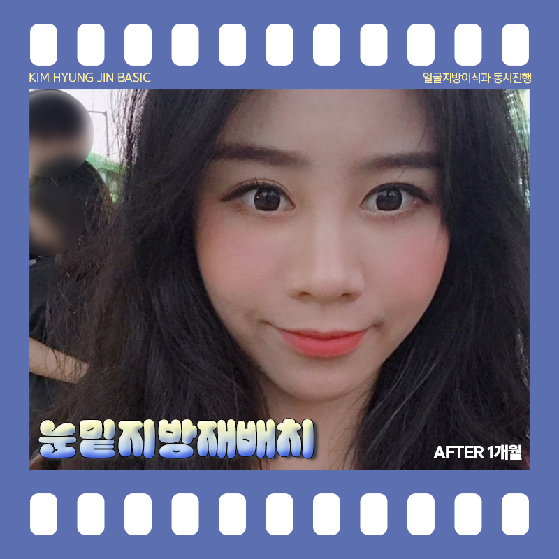 눈밑지방재배치통증! 걱정 안해도 되는 이유 관련 이미지 6