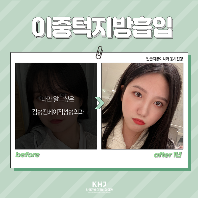 턱살지방흡입수술 어떻게 진행하는지 궁금하셨다면 관련 이미지 6