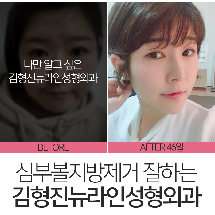 압구정심부볼제거 남다른 후기 관련 이미지 3
