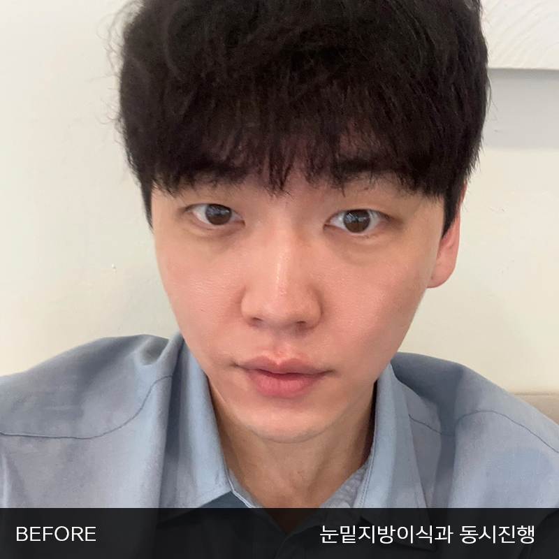 눈밑지방재배치수술이 궁금하시다면 관련 이미지 2
