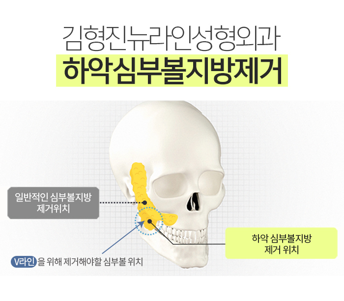 하악심부볼지방제거 잘하는곳에서 해야죠 관련 이미지 4