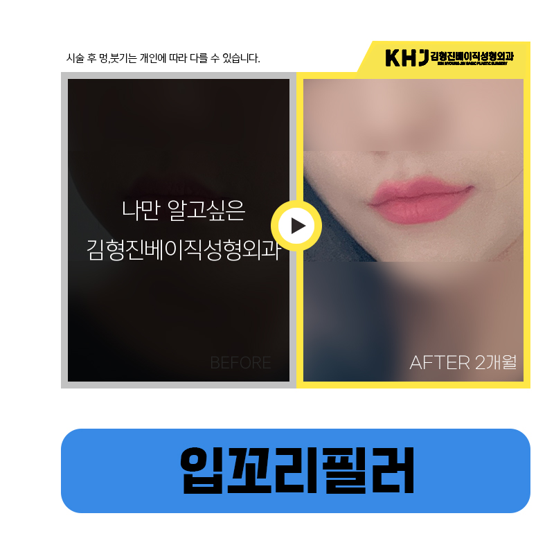 처진입꼬리 교정으로 인상이 달라졌어요 관련 이미지 6