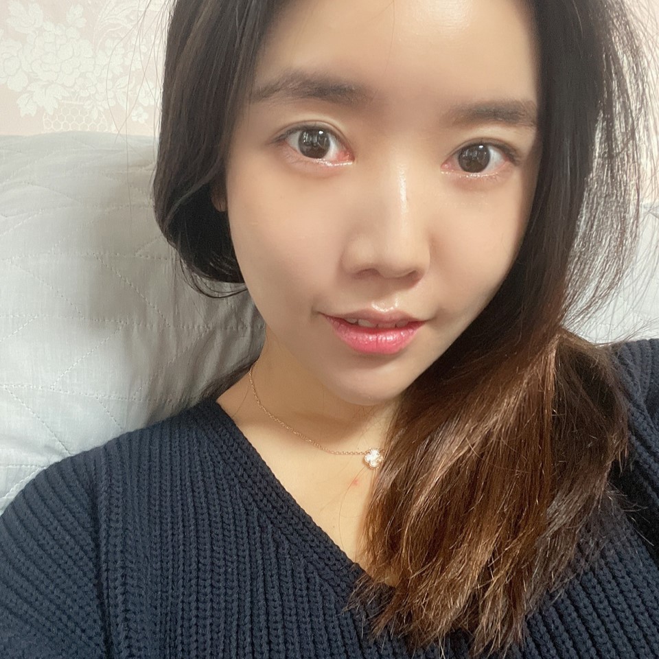 이래서 다들 눈밑지방재배치수술 하나 봐요ㅠㅠ 관련 이미지 2