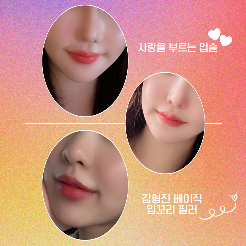 압구정입꼬리필러 하나로 인상이 완전히 달라졌어요ㅠㅠ 관련 이미지 5