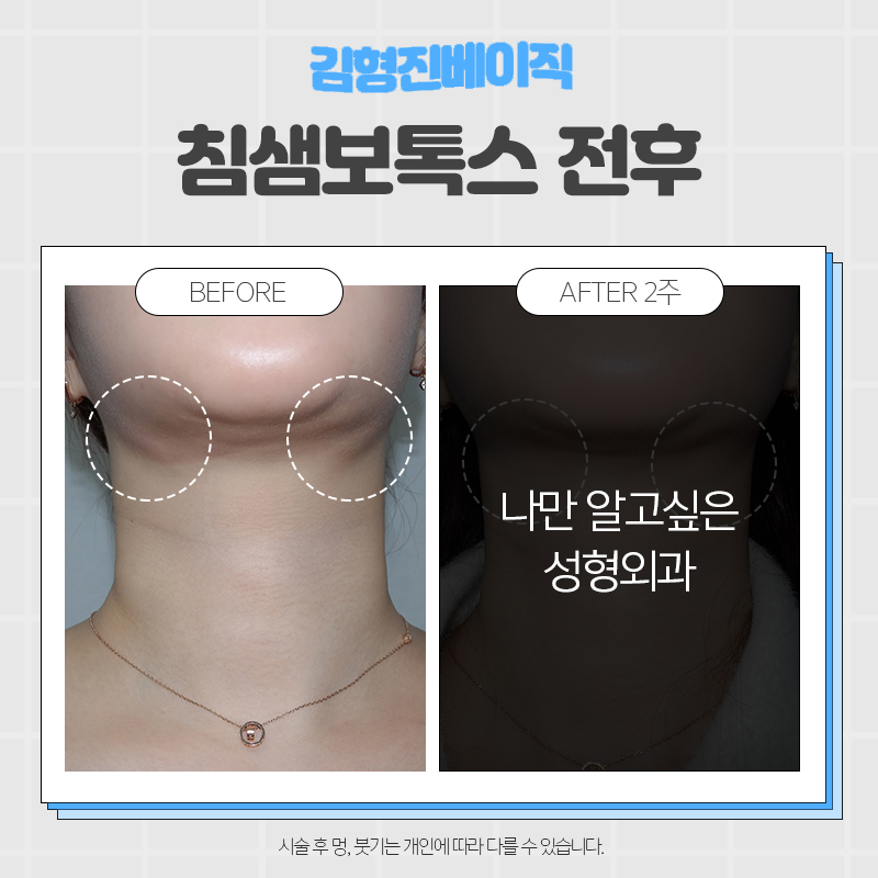 강남침샘보톡스 살을 빼도 턱선을 찾을 수 없다면? 관련 이미지 5