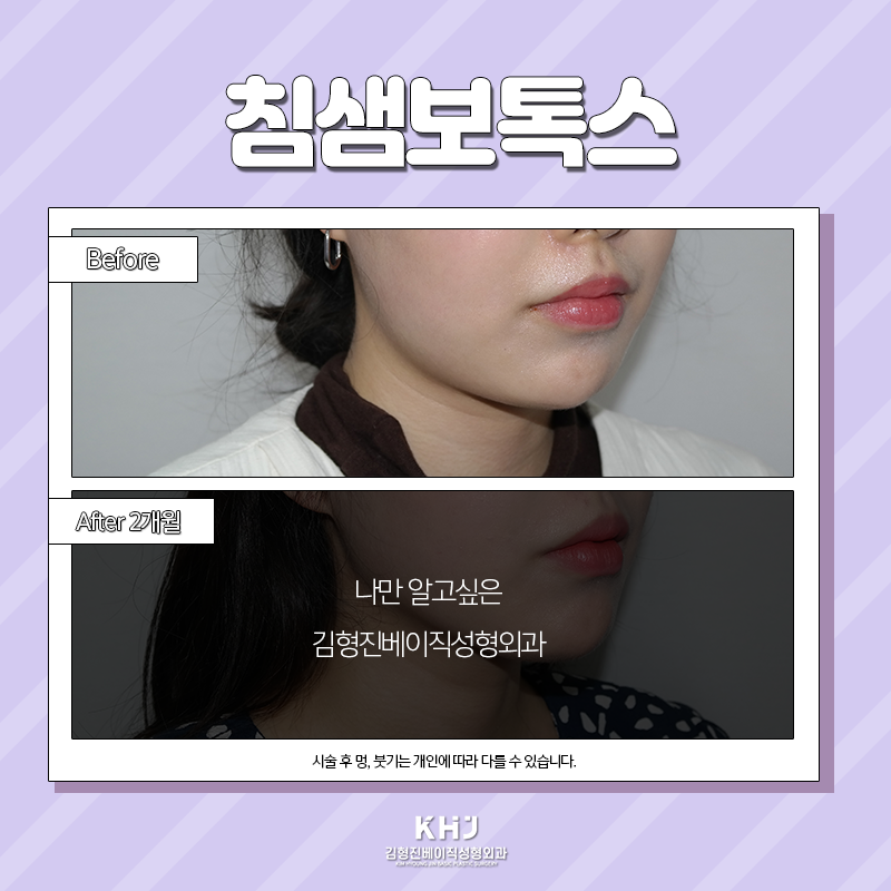 침샘보톡스효과 이렇게나 좋다구요! 관련 이미지 5