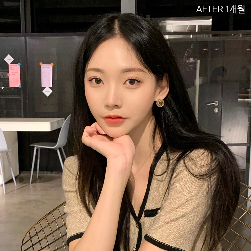 심부볼제거잘하는곳은? 바로 김형진베이직이죠! 관련 이미지 4