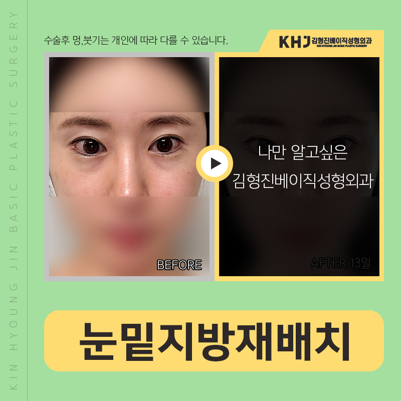 눈밑지방재배치붓기 걱정되신다구요? 관련 이미지 3