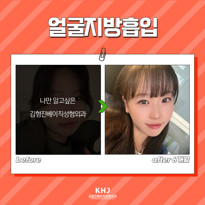 얼굴살빼는법 이렇게 빠르게 될 줄 몰랐어요... 관련 이미지 8