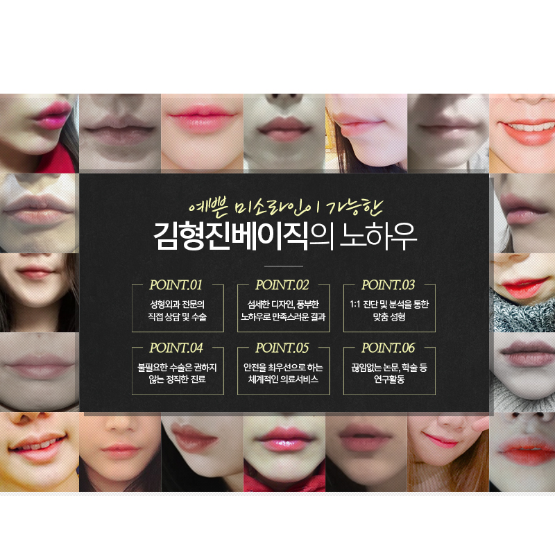 입꼬리필러 맞고 웃상얼굴 되어보기 관련 이미지 6