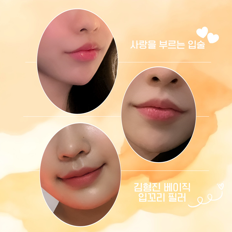 후기 많은 입꼬리필러추천이 필요하다면 여기에요! 관련 이미지 4