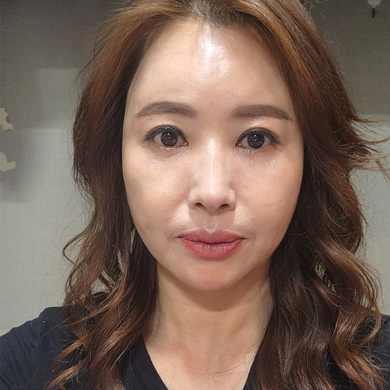 미니하안검흉터 걱정되시죠? 관련 이미지 1