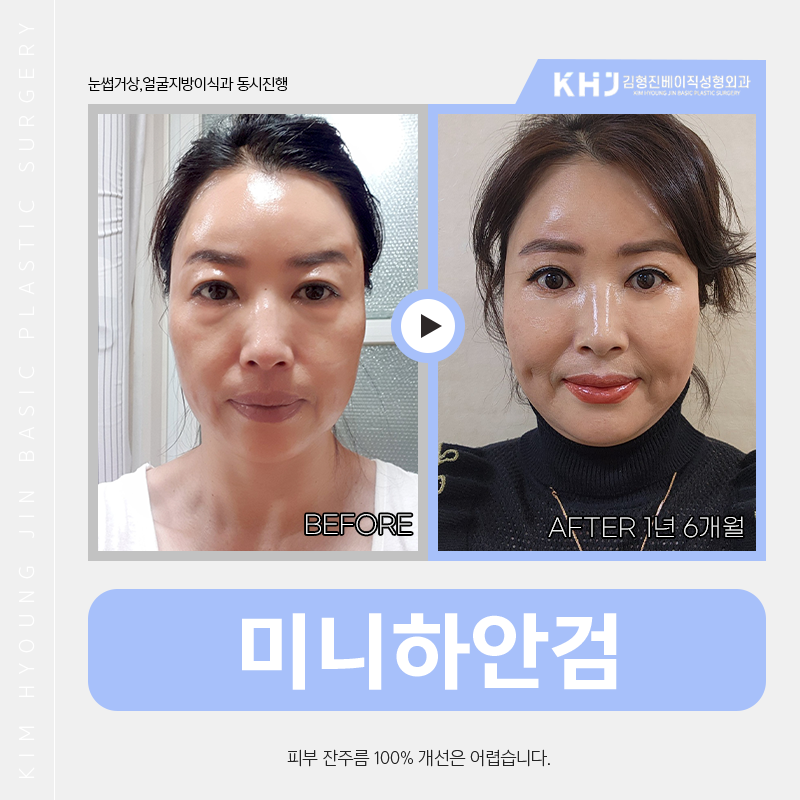 미니하안검절개 걱정 안해도 되는 이유 관련 이미지 2
