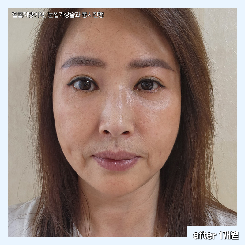 미니하안검흉터 김형진베이직에서는 걱정 없어요! 관련 이미지 4