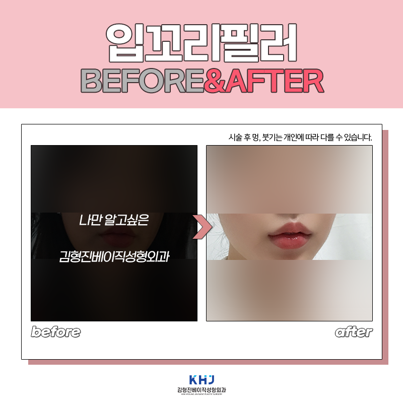 입꼬리필러전후 보고 가실래요? 관련 이미지 6