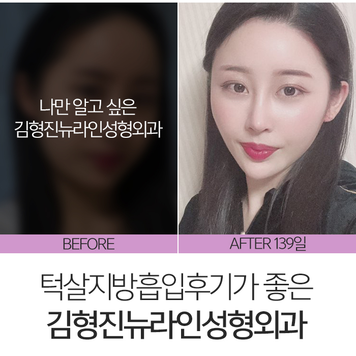 턱살지방흡입후기 확실한 곳 찾아요? 관련 이미지 8