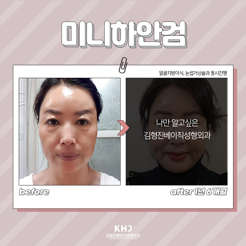 미니하안검절개 깔끔한 곳 찾으신다면 관련 이미지 4