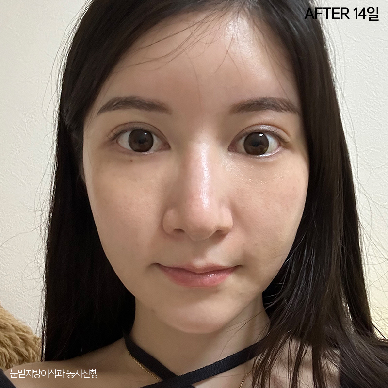 눈밑지방재배치효과 궁금하시죠? 관련 이미지 4