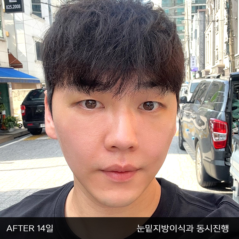 눈밑지방재배치수술이 궁금하시다면 관련 이미지 5